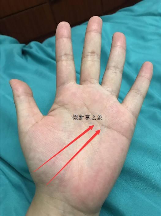 官方发布
:女性假断掌的手相类型